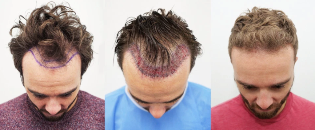 Which Hair Transplantation Method Is the Best For You? - Fly to Cure Blog