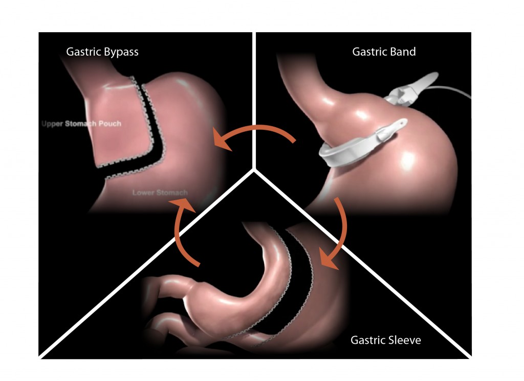 Revision weight loss surgery