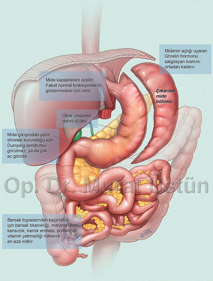 Sleeve Gastrectomy Figure 01