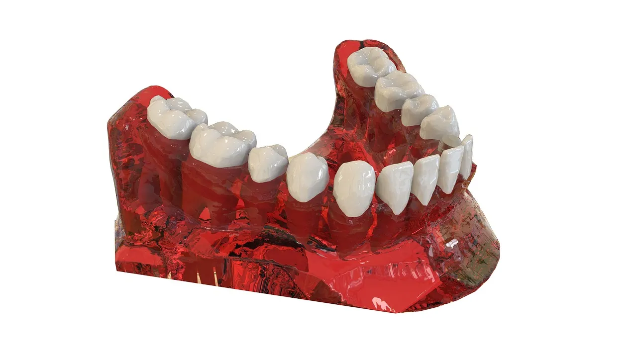 Titanium dental implant model showing jaw placement