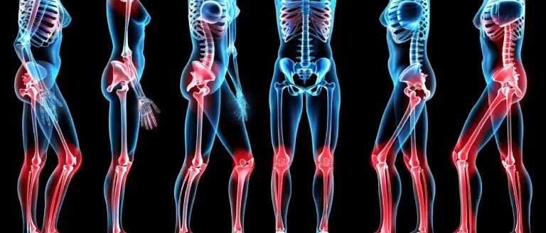 Makoplasty robotic joint replacement